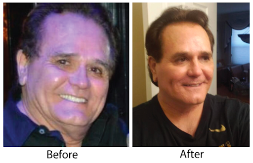 Facelift Facelift